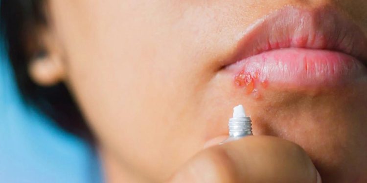 Dudakta uçuk neden çıkar, nasıl geçer? Stresten dudak uçuklaması hangi hastalığın belirtisidir?